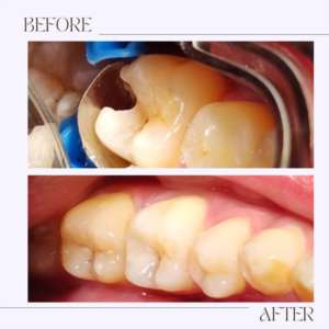 Before and after Composite Filling