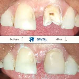 Before and after Composite Filling 