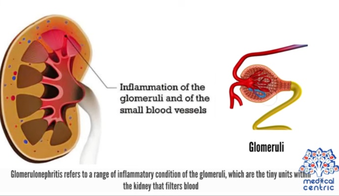 Glomerulonephritis