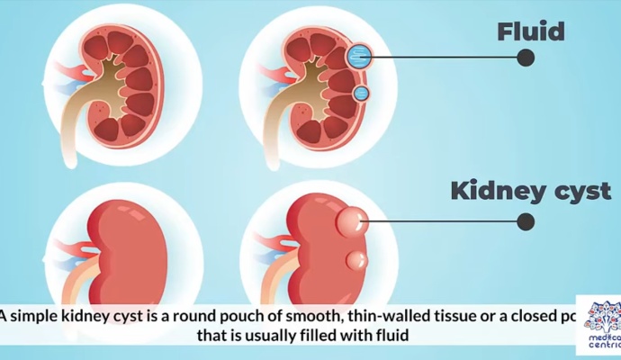 Polycystic Kidney Disease
